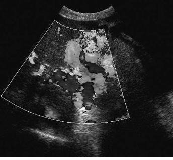 <p><span><strong>A patient presents with a history of cirrhosis. Based on this clinical history, the duplex image of the left upper quadrant is most suspicious for:<br>a. flash artifact<br></strong></span></p><p></p>