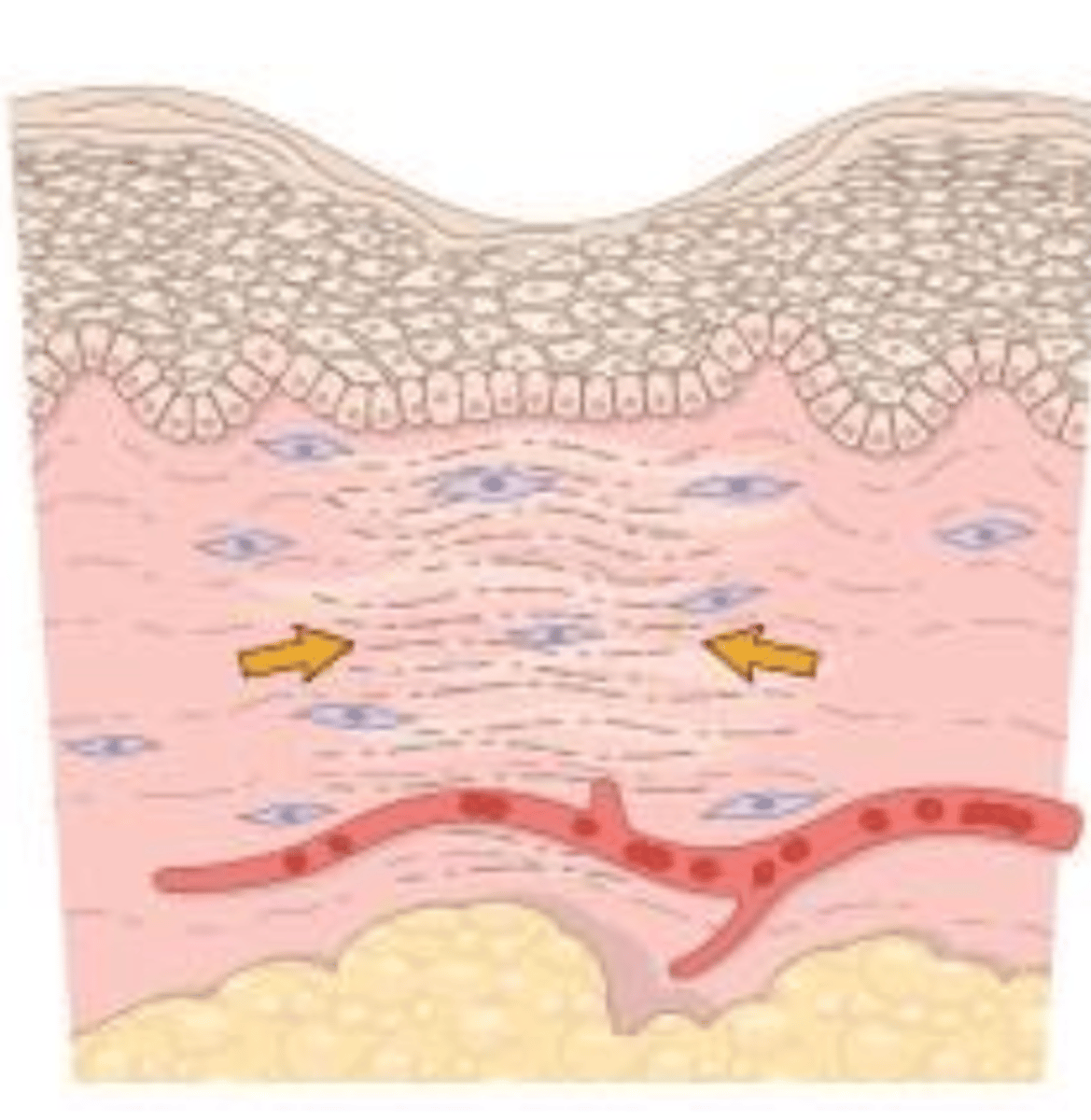 <p>wound contraction is seen in _____ intention (primary/secondary)</p>