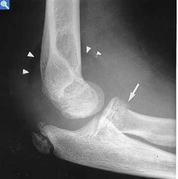 <p>Joint Effusion</p>