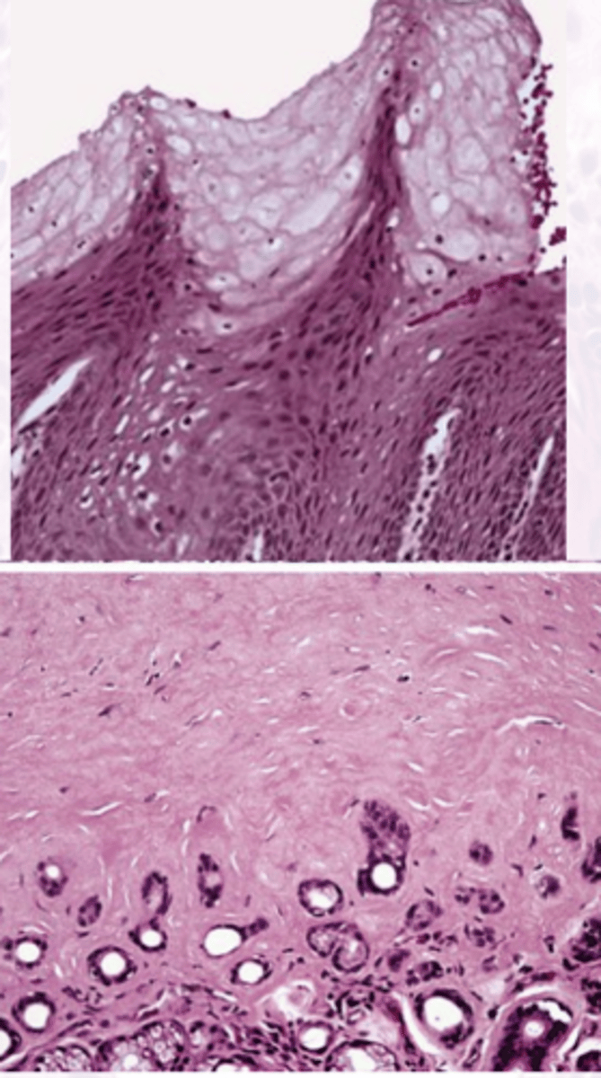 <p>These histology characteristics are indicative of what oral pathology?</p><p>Intracellular Edema &amp; glycogen rich cells</p><p>CHEVRONS</p><p>Amorphous Eosinophilic material</p>