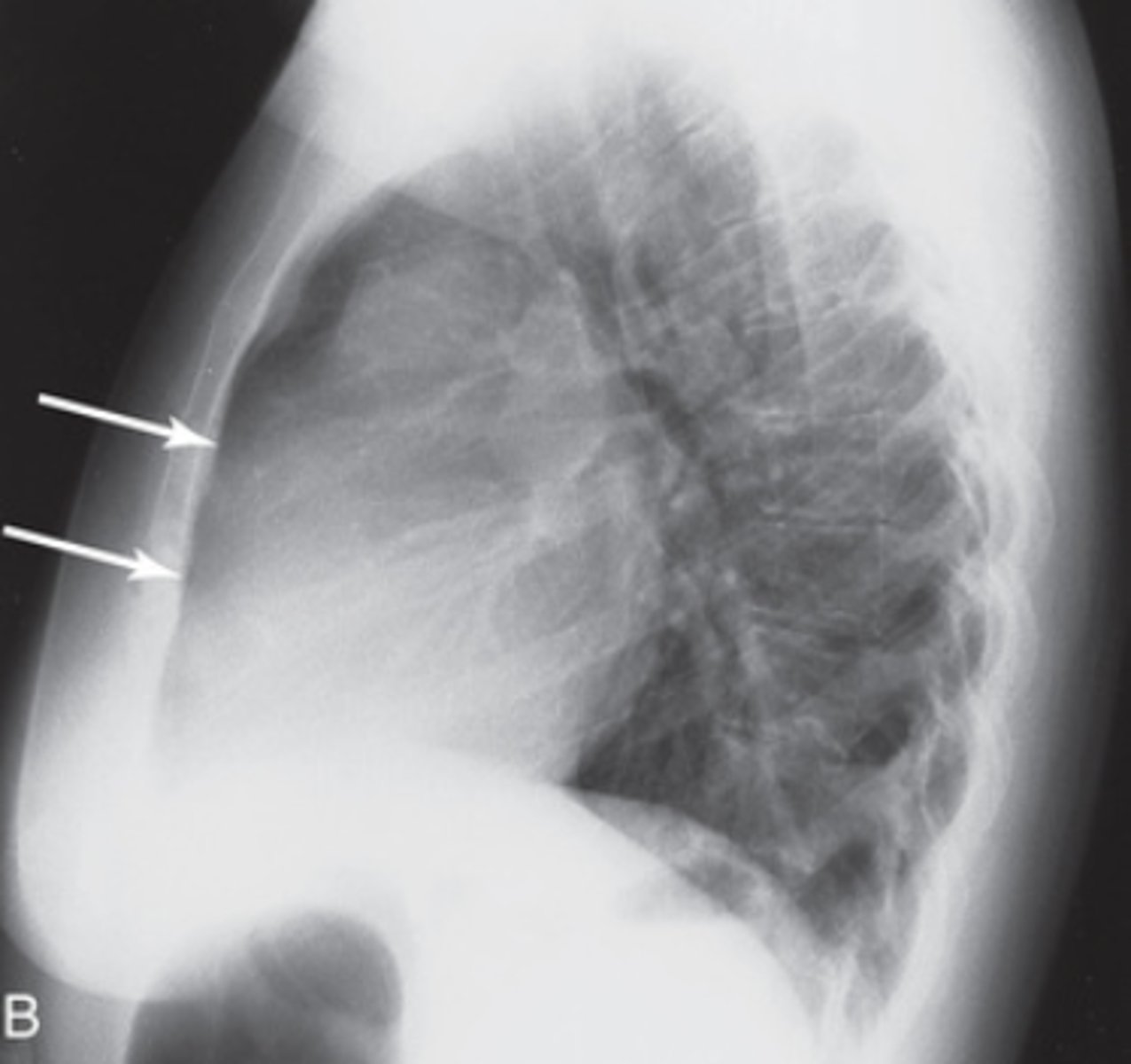 <p>- Right ventricle enlargement</p>