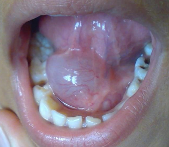 <p>large mass in floor of mouth from sublingual gland </p>