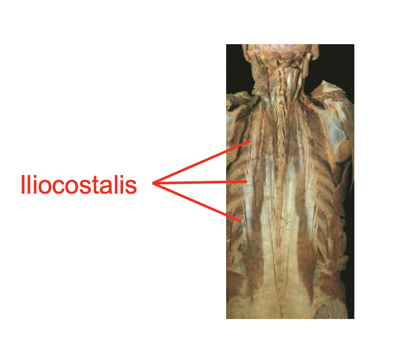 <ul><li><p>illiocostalis&nbsp;</p></li></ul><p></p><p>Origin</p><ul><li><p>Posterior ribs</p></li><li><p>Thoracolumbar aponeurosis</p></li><li><p>iliac crest</p></li><li><p>sacrum</p></li></ul><p>Inseration</p><ul><li><p>Trasnverse process of cervical vertebrae</p></li><li><p>Posterior ribs</p></li></ul><p>Action&nbsp;</p><img src="https://knowt-user-attachments.s3.amazonaws.com/6ad46c79-20a0-4551-9035-16a395caa792.png" data-width="100%" data-align="center"><p></p>