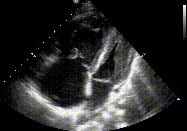 <p>given the following image, what is your qualitative assessment of the right ventricle size?</p>