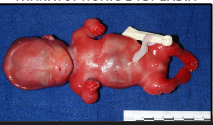 <p>most severe subtype of osteogenesis imperfecta</p>