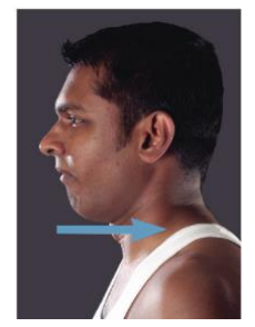 <p>Temporalis mm.</p>