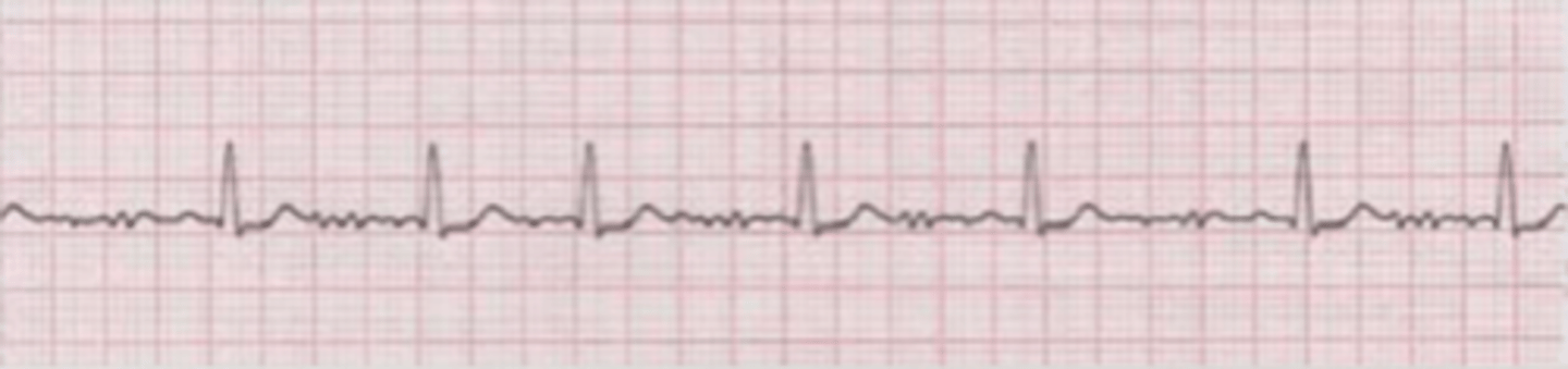 <p>what type of arrhythmia is this?</p>