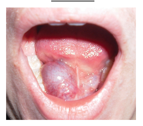<p>Salivary stones that block salivary flow</p><ul><li><p>can cause ranula to form.</p></li></ul><p>Ranula - <span>filled with saliva that has leaked from a damaged salivary gland. This leakage leads to a fluid-filled swelling, often appearing bluish or translucent. </span></p><p></p>
