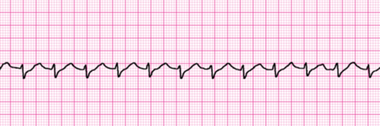 <p>R = 125</p><p>No apparent P-waves</p>