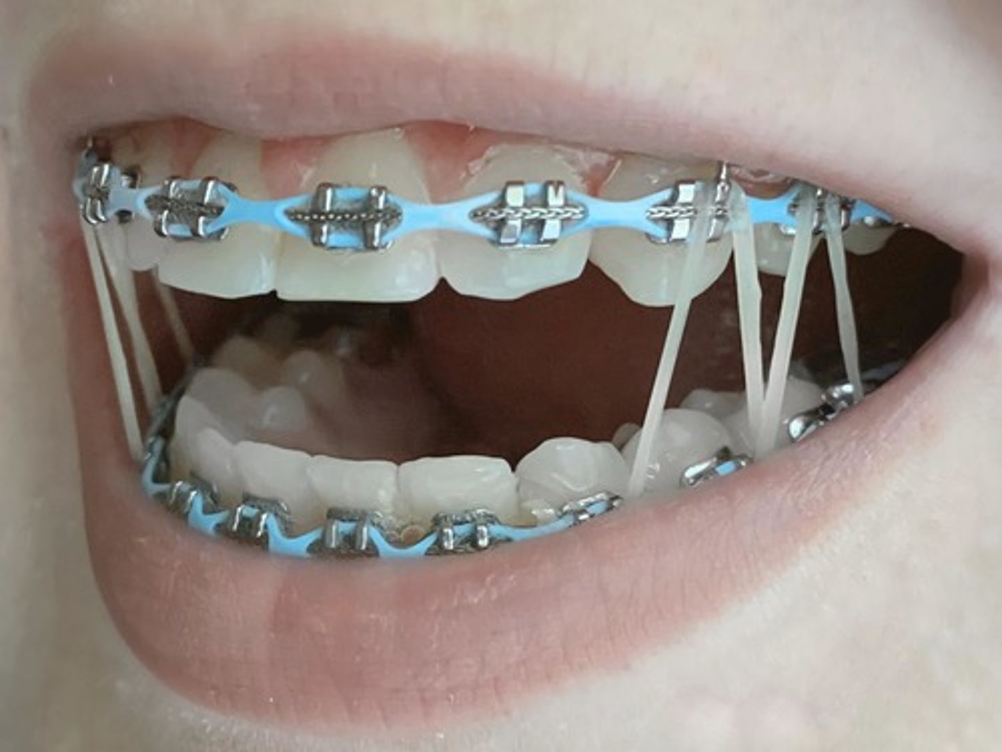 <p>Changes shape in response to a change in temperature or electrical input.</p><p>For example, nitinol wire in dental braces changes length in response to a change in temperature.</p><p>Dental braces, self-closing windows, aeroplane wing flaps, bioengineering such as stents, bone plates and screws,</p>