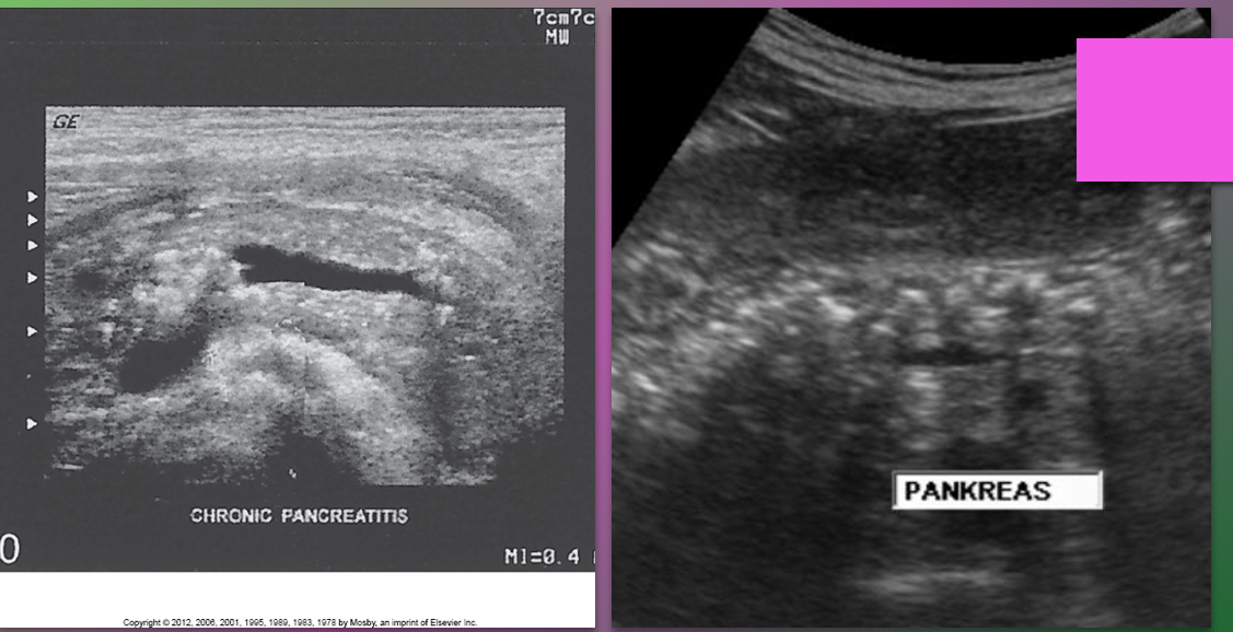 <p>Chronic obstructive pancreatitis presents with non-______ distribution, less ductal _______ damage and ______ stones </p>