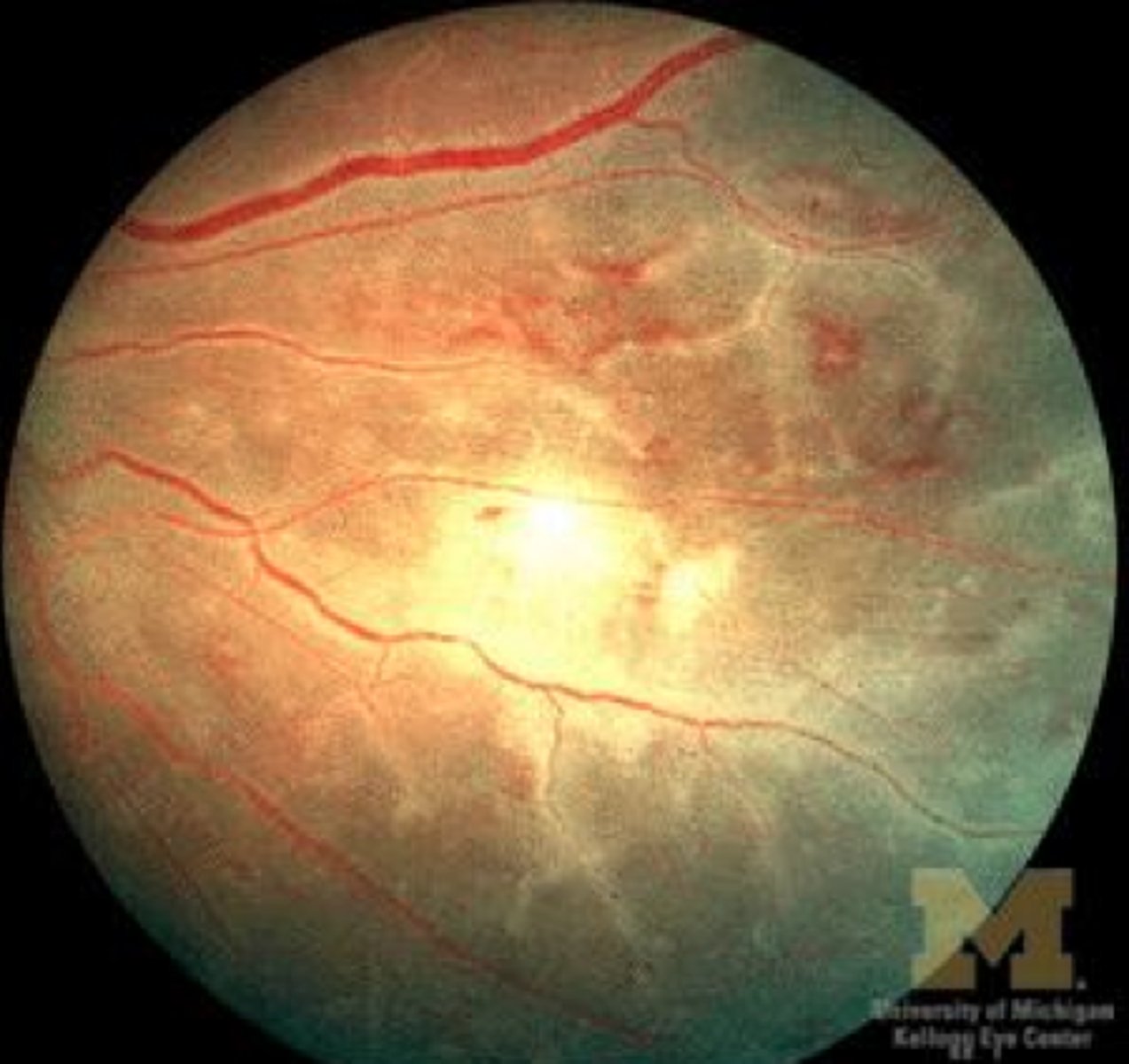 <p>Retinal Vasculitis</p>