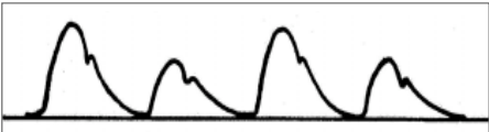 <p>Pressure of the pulse: alternates</p><p>Contour: amplitude varies, rhythm same</p><p>Cause: left ventricular failure </p>