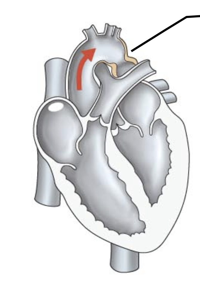 <p>what kind of congenital heart defect is this?</p>
