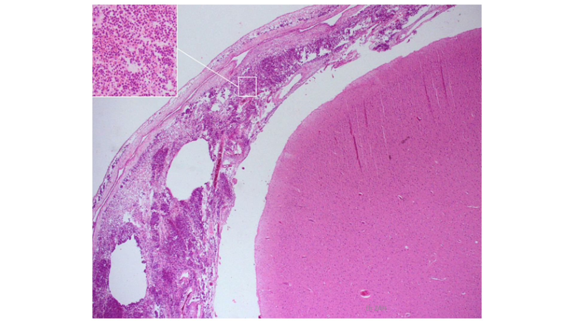 <p>Acute Purulent Meningitis</p>