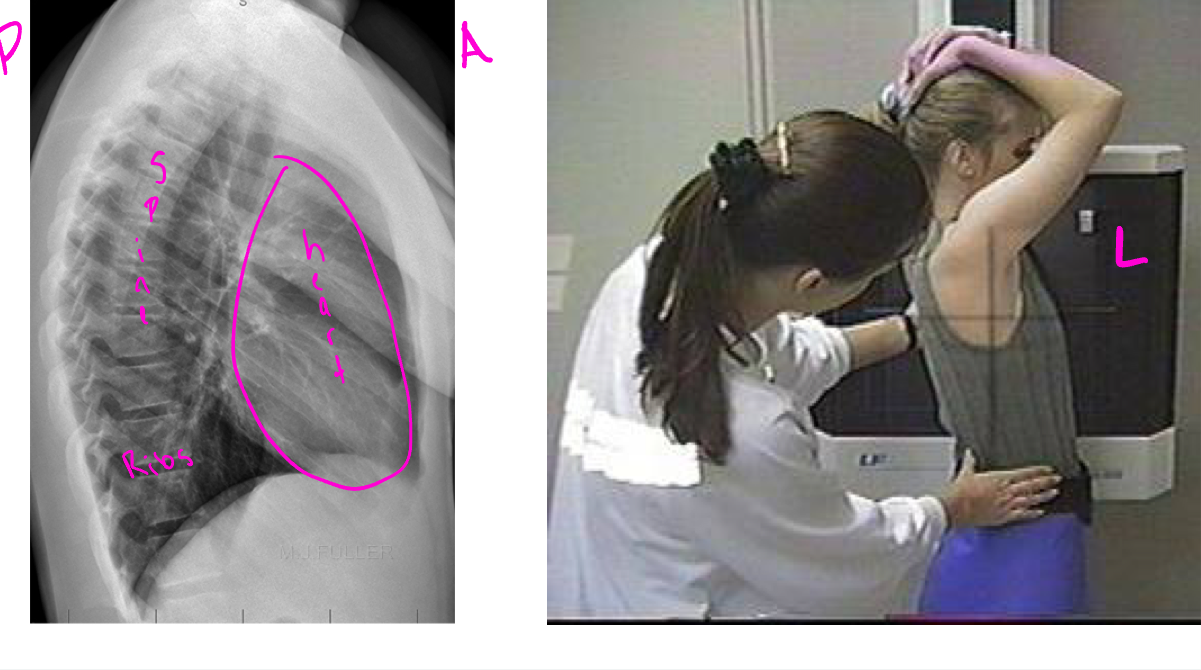 <p>x-ray beam passes from one side of the patient or body to the other</p>
