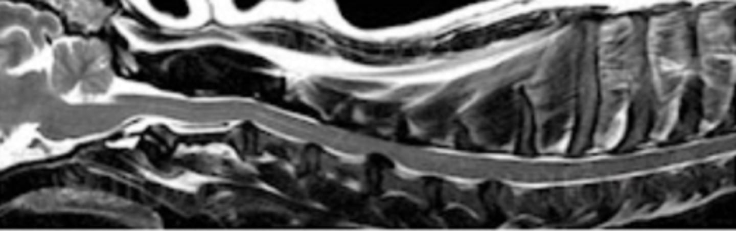 <p>Extrusion at the level of the cervical C4/5 in T2-dependent sequence</p>