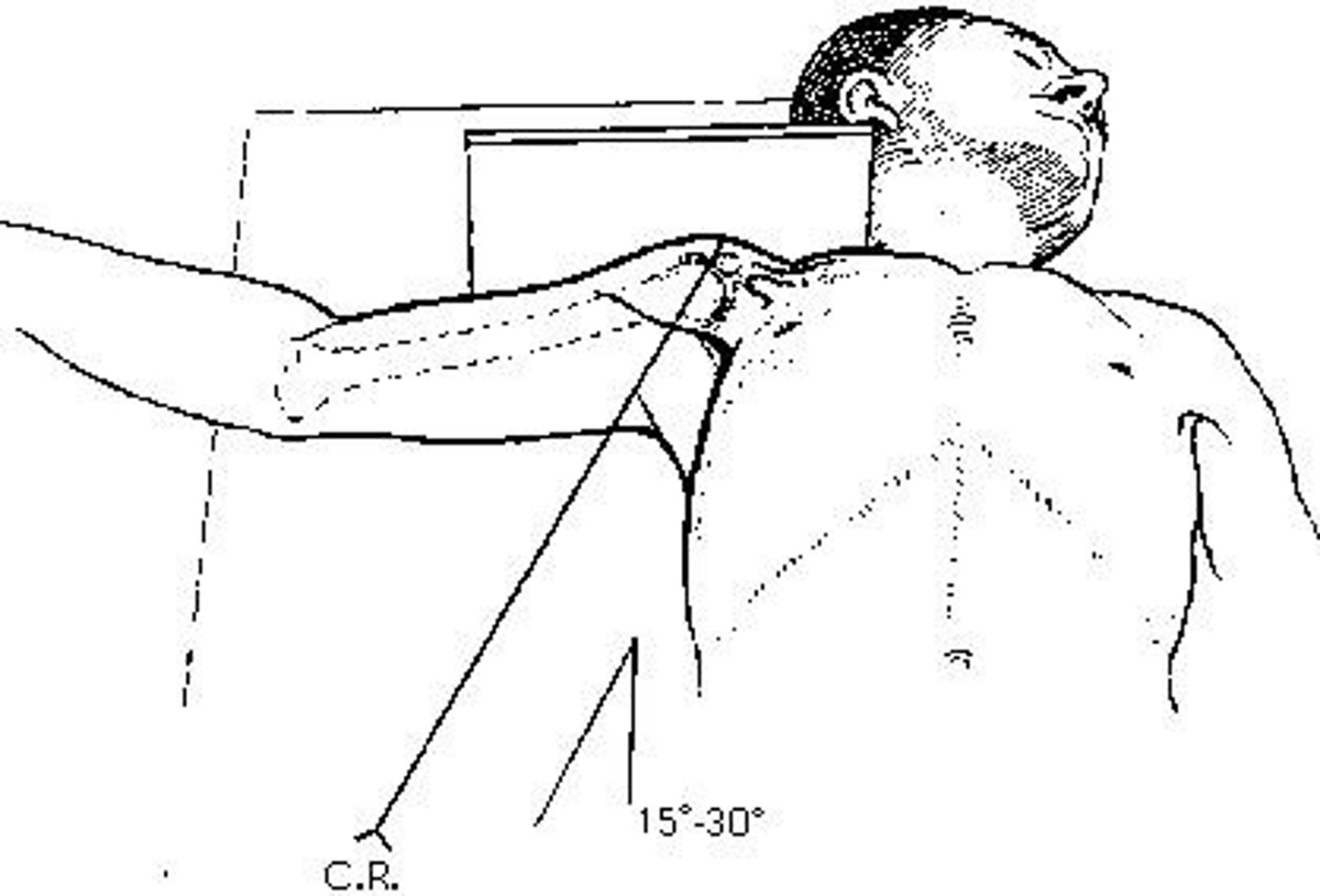 <p>The projection of the shoulder demonstrated in the figure above is the:</p><p>axiolateral</p><p>inferosuperior axial (Lawrence)</p><p>transthoracic lateral (Lawrence)</p><p>acromioclavicular (Pearson)</p>