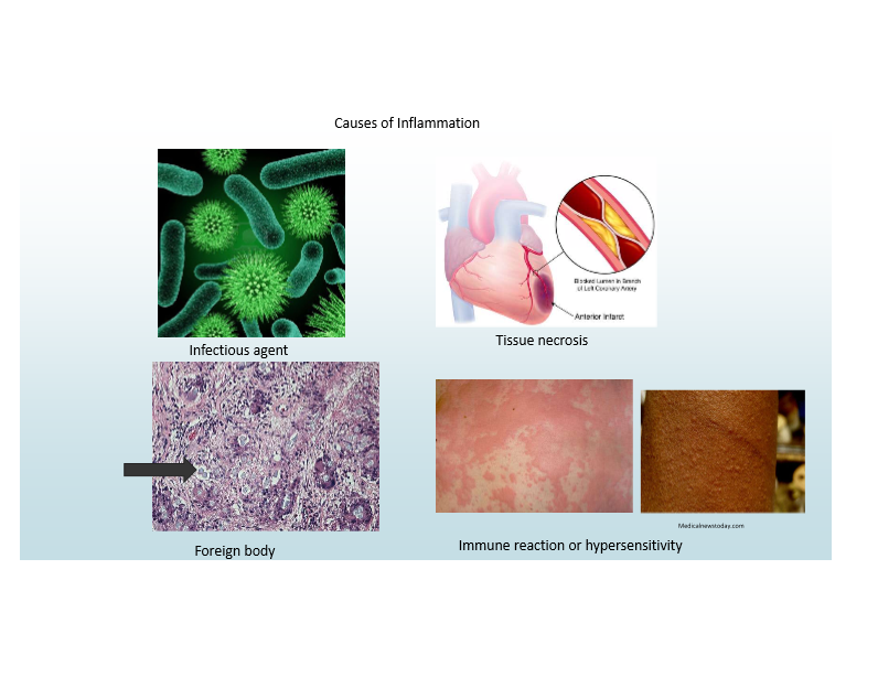 <p>Infections (PAMPs)</p><ul><li><p>Most common</p></li></ul><p>Tissue necrosis (DAMPs)</p><p>Foreign bodies</p><p>Immune reactions (hypersensitivity)</p>