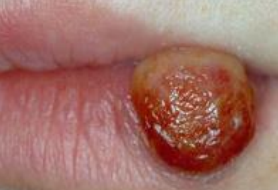 <p>Identify the descriptive term for this lesion</p>