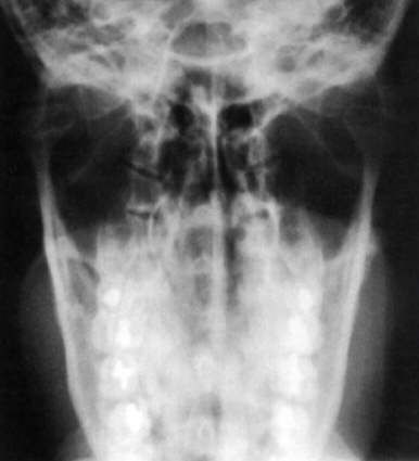 <p>What is this X-ray demonstrating?</p>
