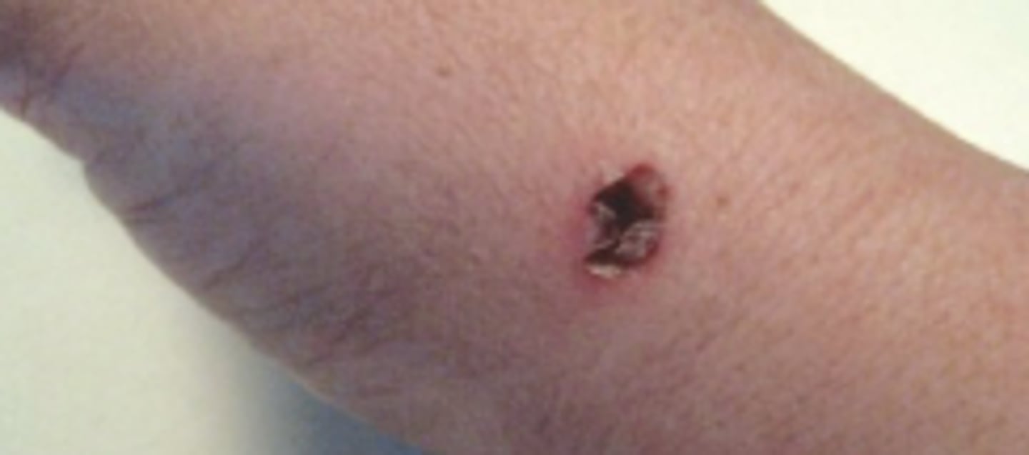 <p>Electrochemical skin burn!</p><p>Initially burn lesion pink and raised → gray → oozing within hours</p>