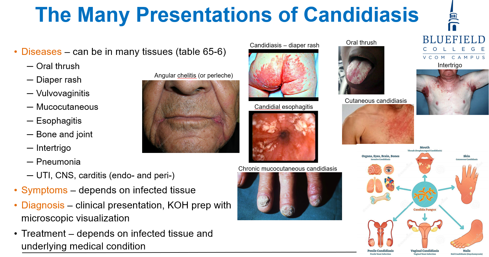 <p>D. Erythema nodosum<br></p><p><em>Candida</em> causes <strong>mucocutaneous infections</strong> like <strong>thrush</strong> and <strong>intertrigo</strong>, not <strong>immune-mediated rashes</strong> like erythema nodosum.</p>