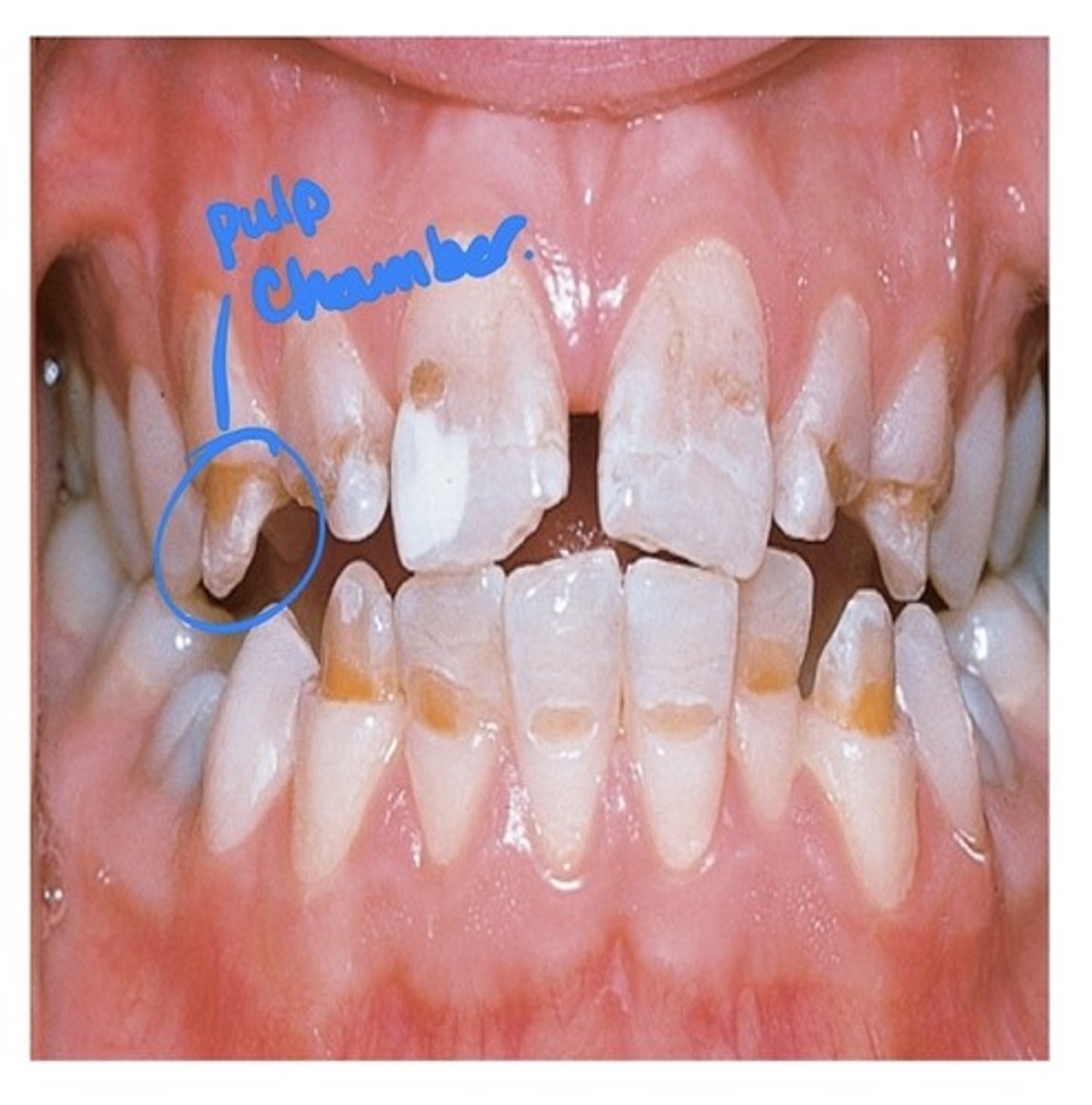 <p>This is an umbrella term. An incomplete or defective formation of enamel. May be due to many factors, including: amelogenesis imperfecta (most severe), febrile illness, vitamin deficiency, infection of a deciduous tooth, ingestion of fluoride, congenital syphilis, birth injury, premature birth, idiopathic factors.</p>