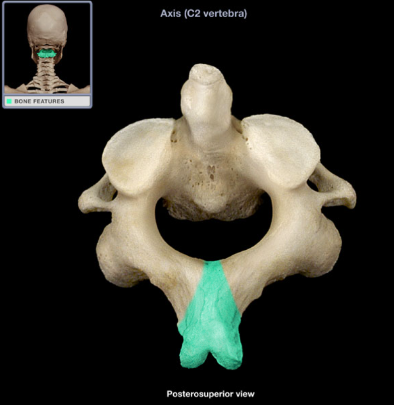 <ul><li><p>Location: Axis (posterior)</p></li><li><p>Description: Unpaired posterior midline projection from vertebral arch, Process has characteristic bifid (split) form</p></li></ul><p></p>