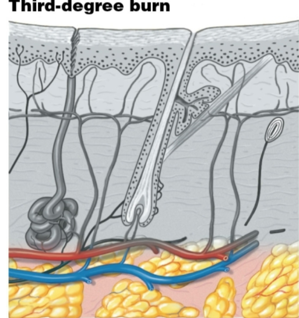 <ol><li><p>Third degree burn</p></li><li><p>Why? - because these type of burns cannot fix themselves, so a skin graft is needed</p></li></ol><p></p>