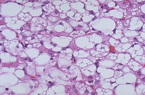 <ol><li><p>Microscopic feature of liposarcoma</p></li><li><p>Preferred treatment of sarcomas</p></li><li><p>Response of sarcomas to chemo/radiation</p></li></ol><p></p>