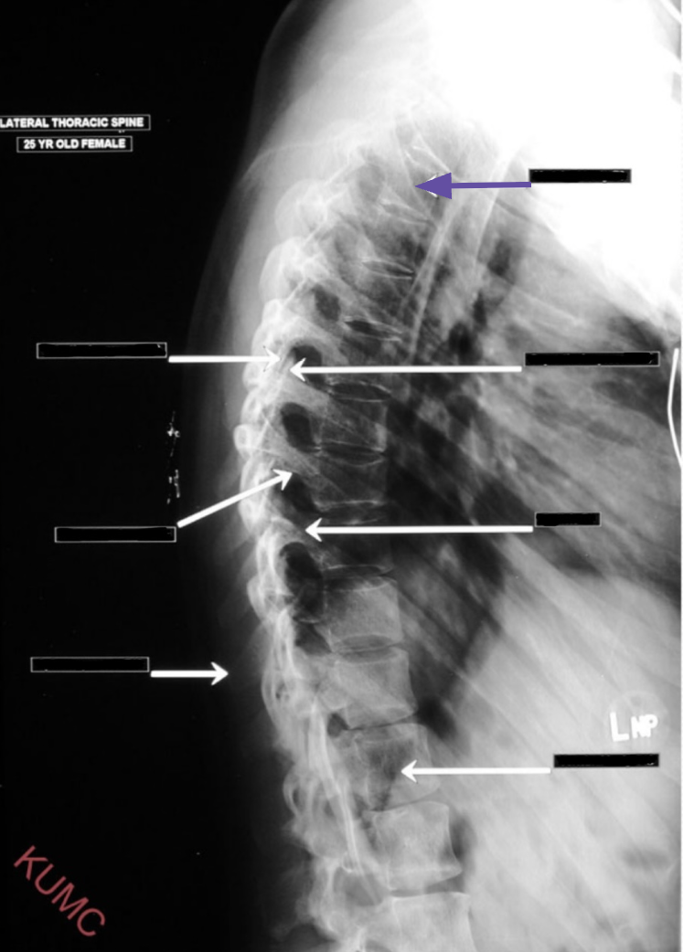 <p>What structure is referenced by the arrow highlighted in purple?</p>