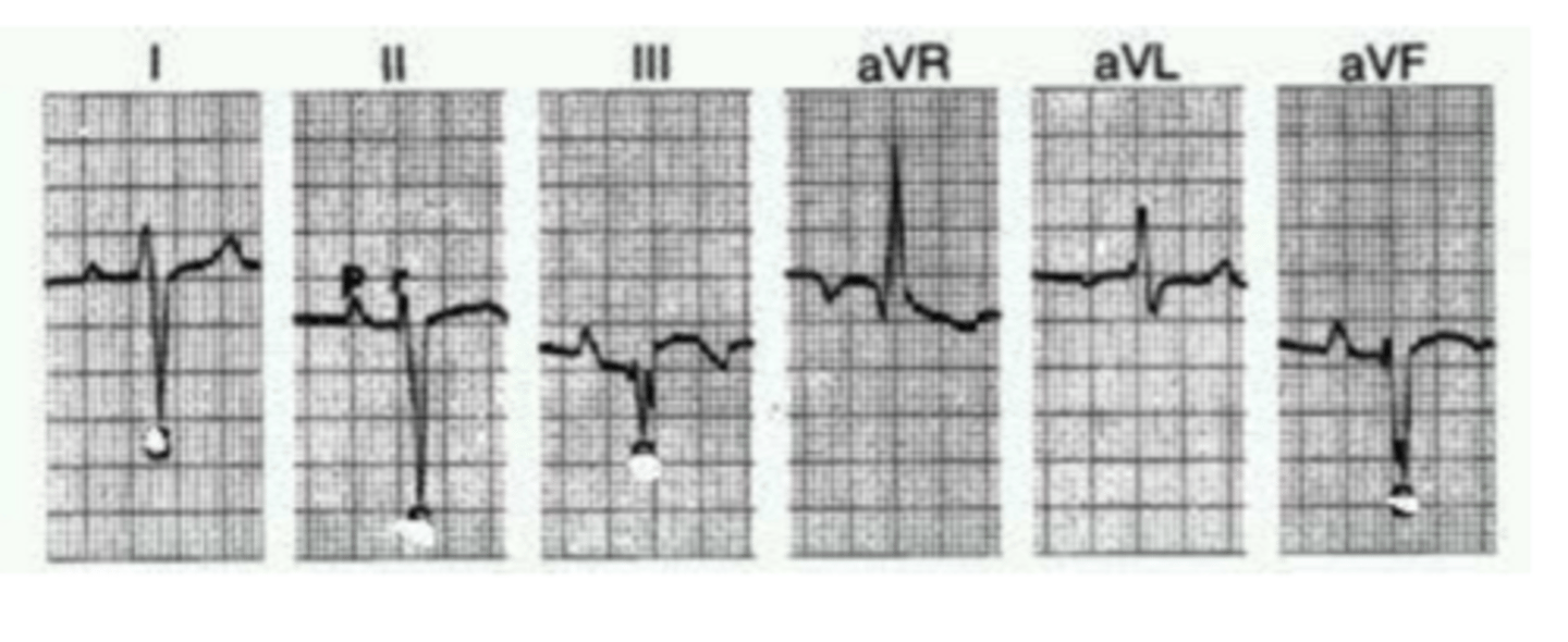 <p>What is the Mean Electrical Axis of this dog? Is it normal or abnormal? What if this was a cat?</p>