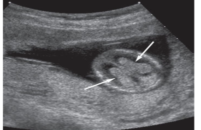 <p><span>Choroid plexus within the lateral ventricles. Choroid plexus (arrows) is seen within the lateral ventricle of this 13-week gestation fetus.</span></p>