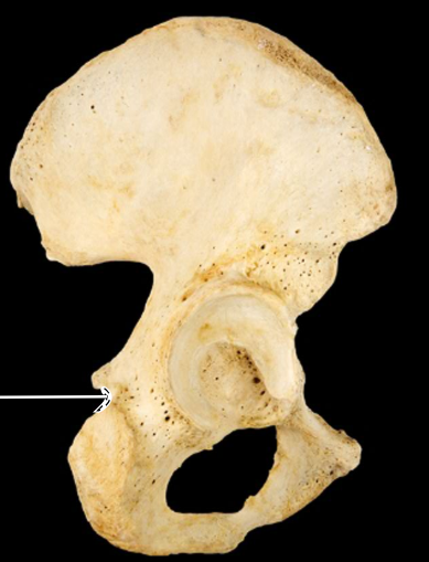 <p>Hip bone, lateral view, right ischium</p>