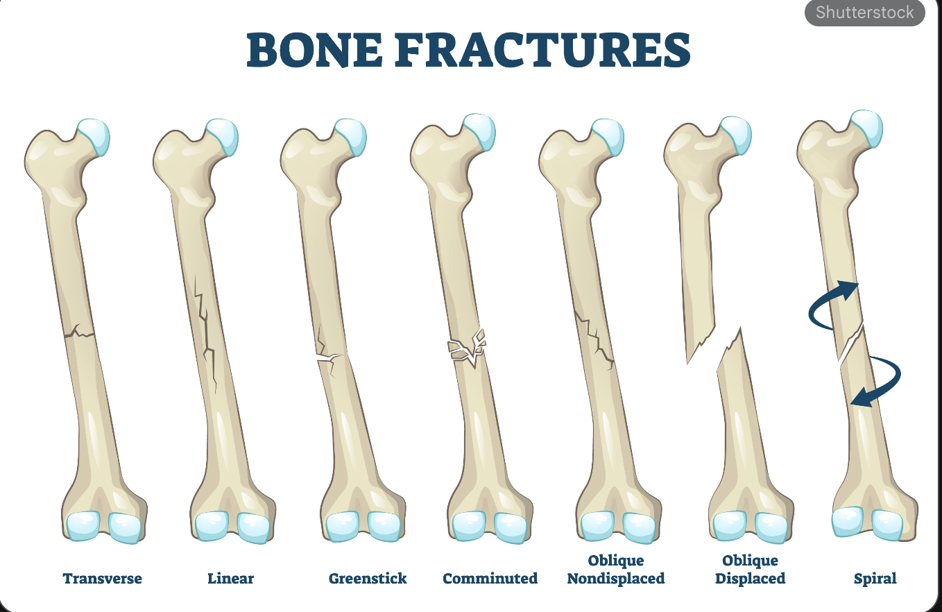 <p>What is a <strong>comminuted fracture</strong>?</p>