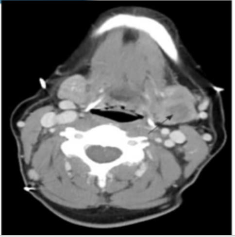 <p>So our CT comes back positive for sialadenitis, how are we treating our patient?</p>