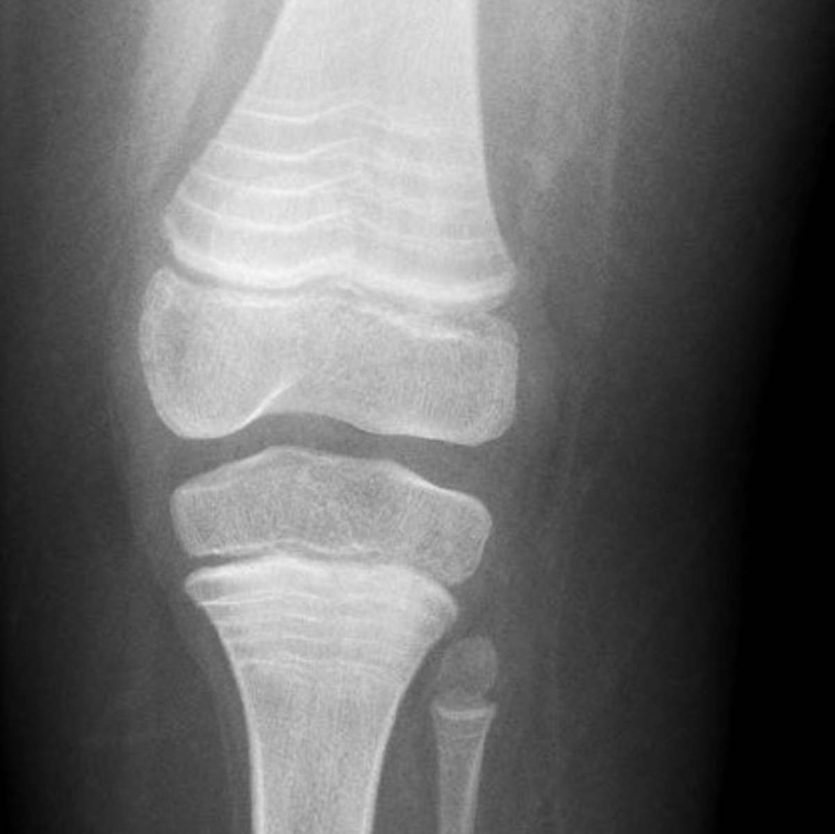 <p><strong>_____________:</strong></p><p>oOccur in the distal tibia</p><p>oDue to a period of arrested growth – perhaps sickness</p>