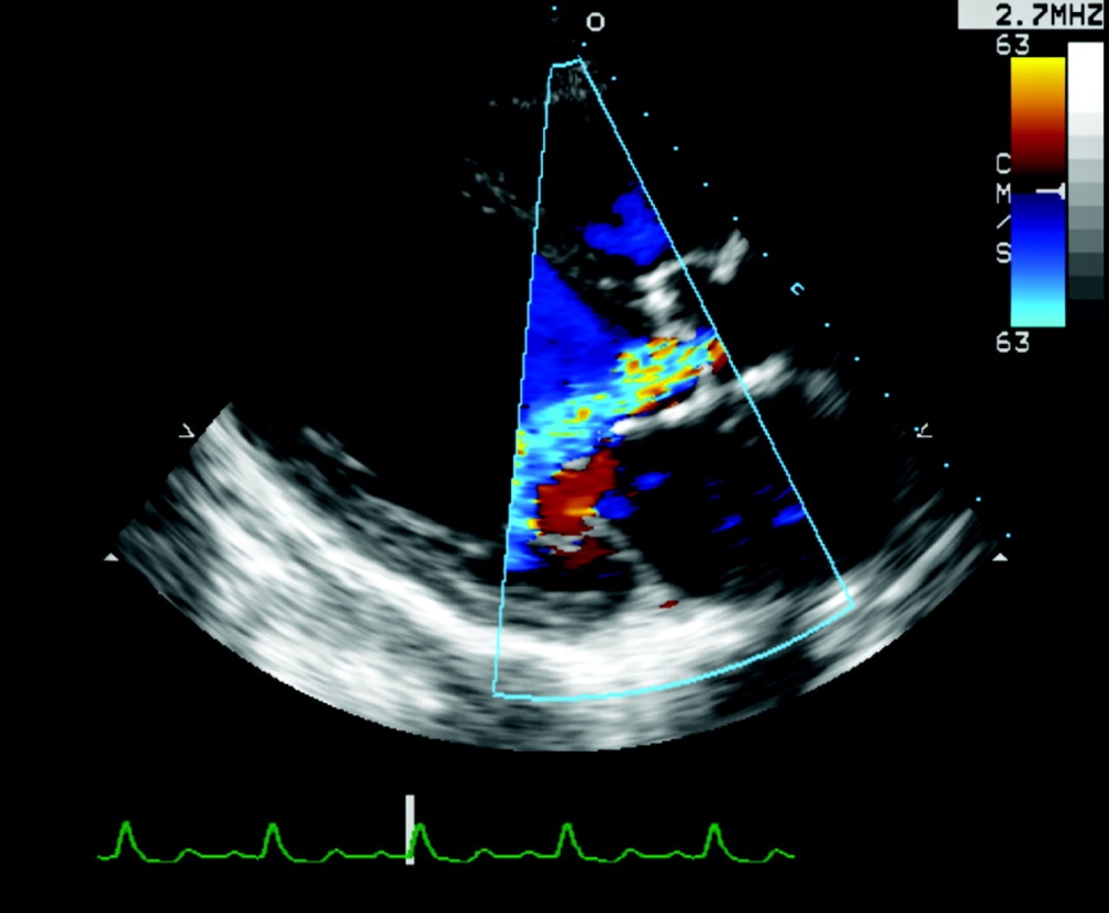 <p>Which cusps of the Aortic Valve (AOV) are seen in the PSLA view?</p>