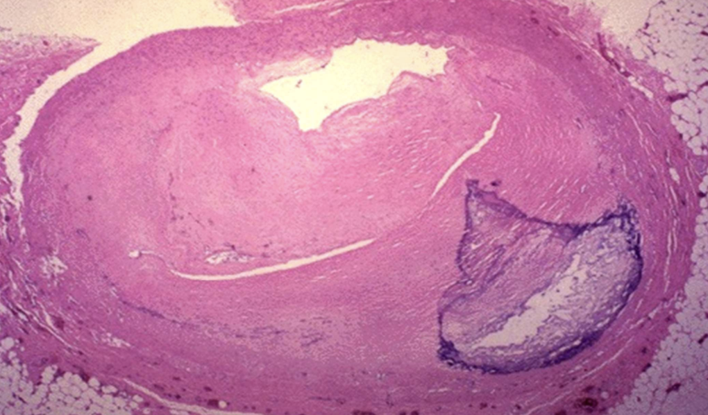 <p>Dystrophic calcification within atherosclerotic plaques that narrows vessels.</p>