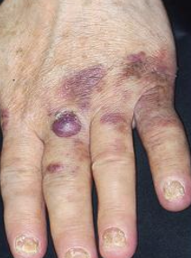 <p>Multiple vascular neoplasms on skin and intra oral</p>