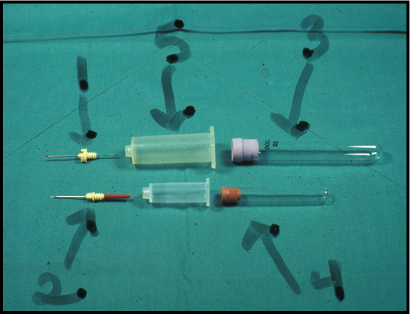 <p>Vacuum blood collection system with needle<strong>(double needle</strong>), holder, and collection tubes.</p><p><span>1.Needle</span></p><p><span>2.Needle</span></p><p><span>3.Vacuum tube</span></p><p><span>4.Vacuum tube</span></p><p><span>5.Holder</span></p><p><span>can fill multiple tubes with one stick</span></p>