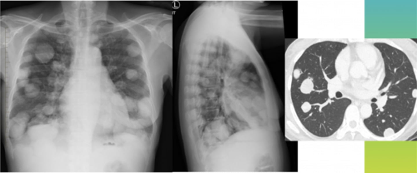 <p>Patient has a previous history of pancreatic cancer</p>