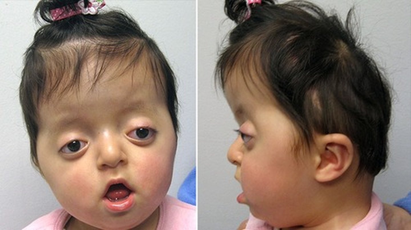 <p>•Abnormally shaped head</p><p>•Wide set eyes</p><p>•Beaked nose</p><p>•Underdeveloped upper jaw</p><p>•Thumbs and big toe point away from other digits, may have webbing or fusion</p><p>Hearing issues</p>