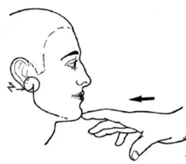 <p>Pression antéropostérieure sur la pointe du menton qui réveille une douleur préauriculaire</p>