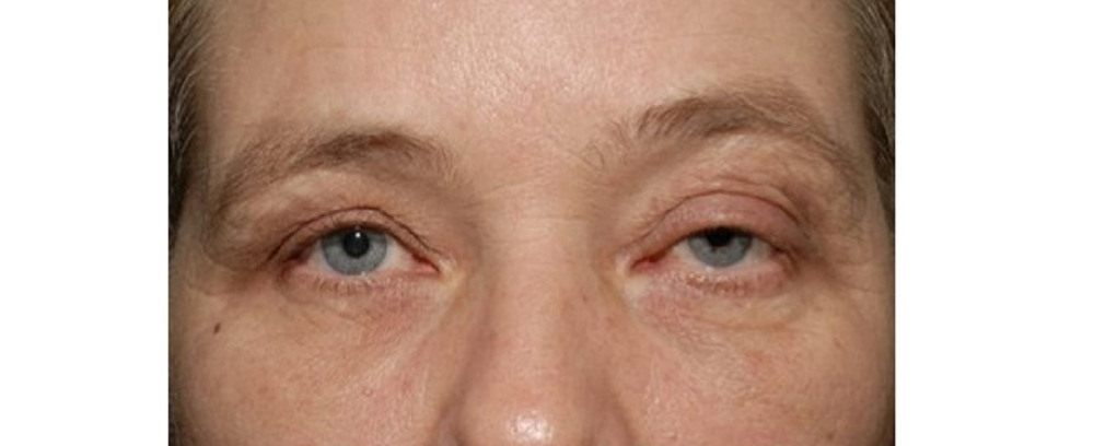 <ul><li><p><span>Proptosis - eyes bulge from natural position&nbsp;</span></p></li><li><p><span>Dipl + distorted vision</span></p></li><li><p><span>Pain</span></p></li></ul><p></p>