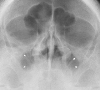<p>PT presents with toothache and has recently fallen ill with a viral infection<br><br>What pathology is present?</p>