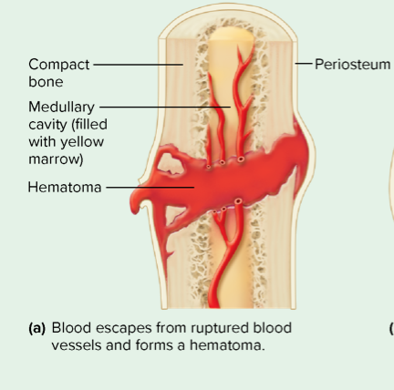step 1 of bone repair 