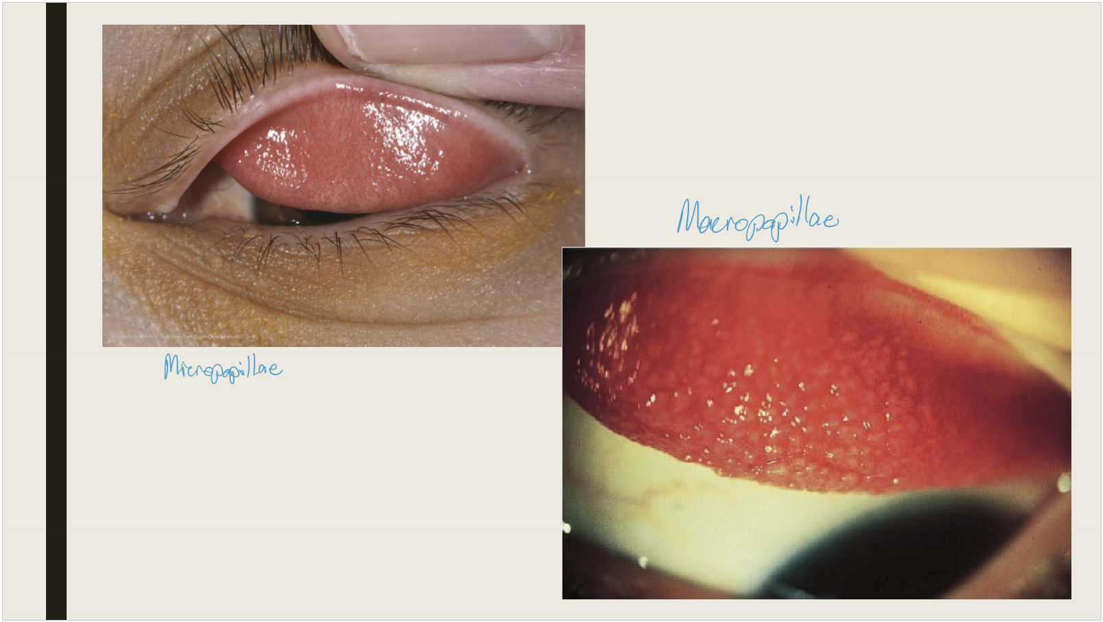 <ul><li><p>Bacterial infections</p></li><li><p>Allergic reactions</p></li><li><p>Chronic marginal blepharitis</p></li><li><p>Contact lens wear</p></li><li><p>Superior limbal keratoconjunctivitis</p></li><li><p>Floppy eyelid syndrome</p></li></ul><p></p>