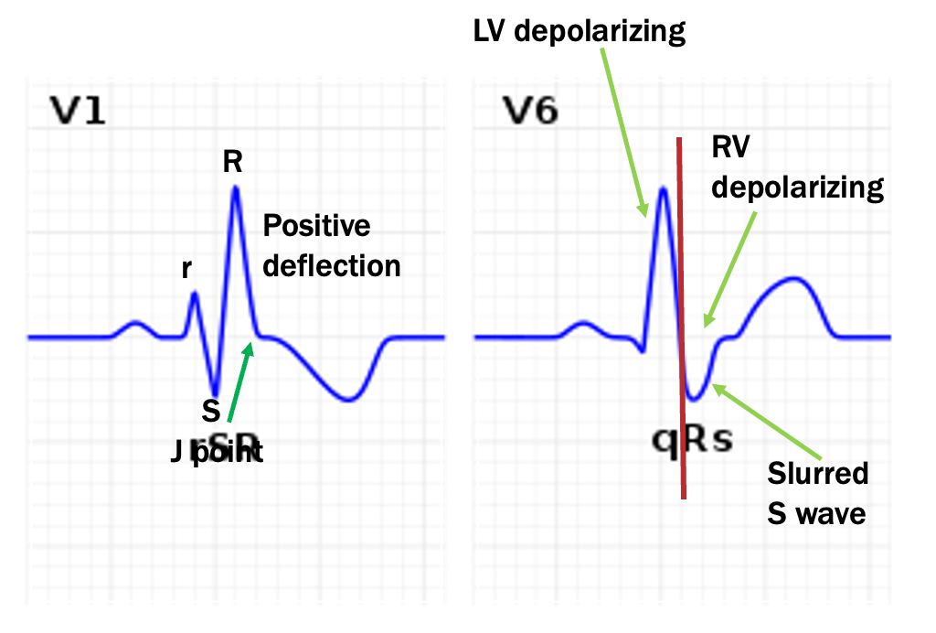 <p>QRS longer 0.12 s / 3 small boxes in V1</p><p>rSR pattern in V1- pos deflection behind J point</p><p>double QRs- slurred S waves in lateral leads (I, aVL, V5, V6) best seen in V6</p>